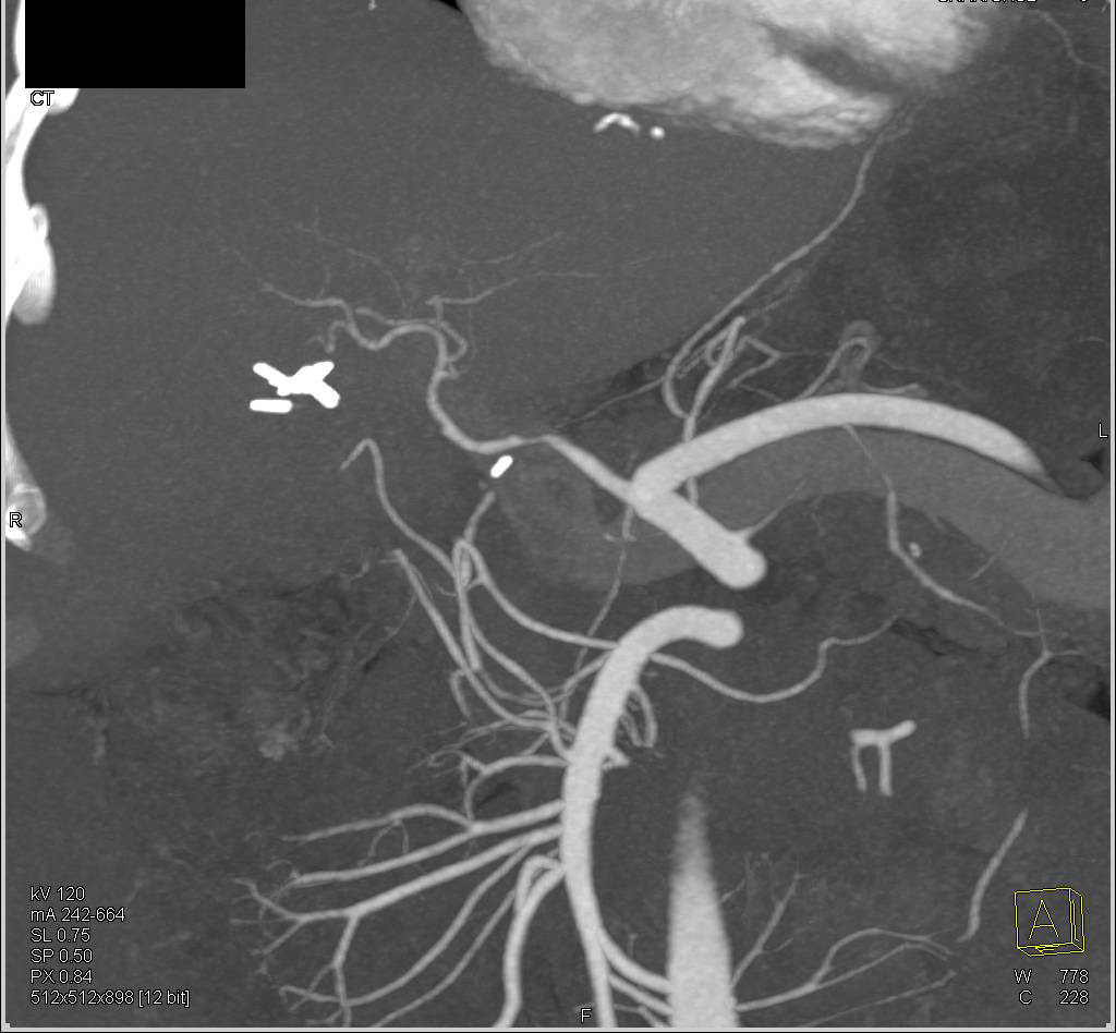 Hepatic Artery Stenosis In A Liver Transplant Patient Liver Case