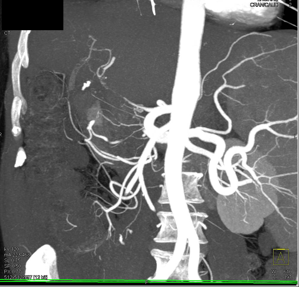 Hepatic Artery Occlusion in Liver Tx Patient - CTisus CT Scan