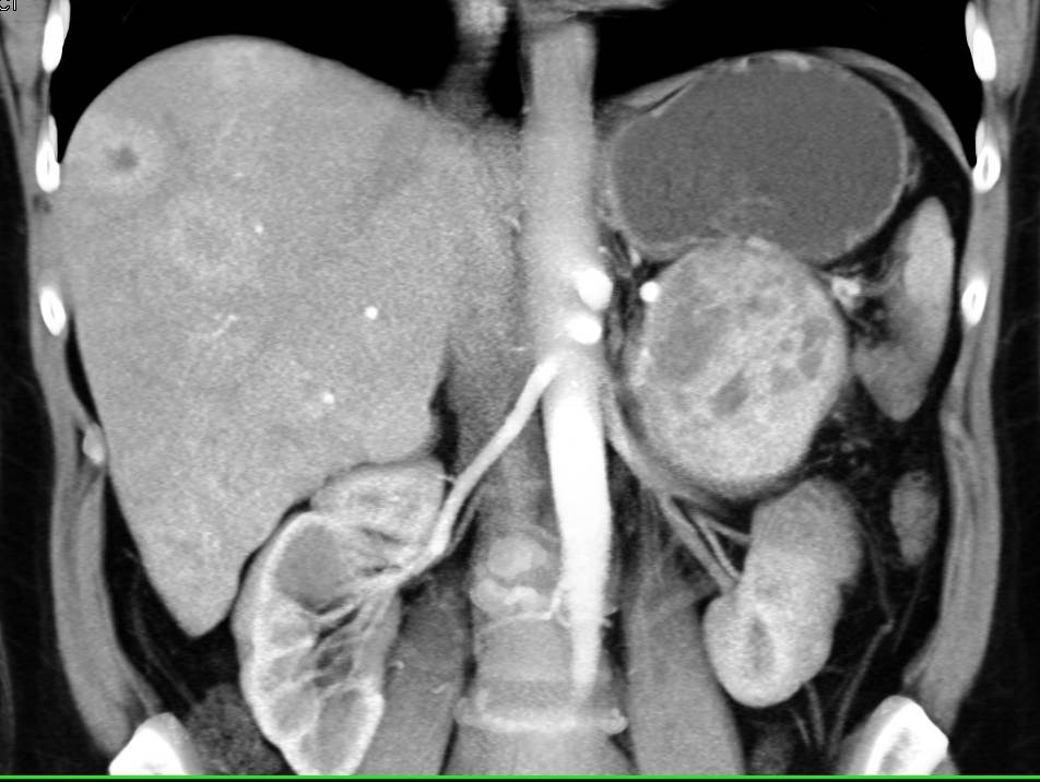 Vascular Liver Metastases due to a Neuroendocrine Tumor - CTisus CT Scan