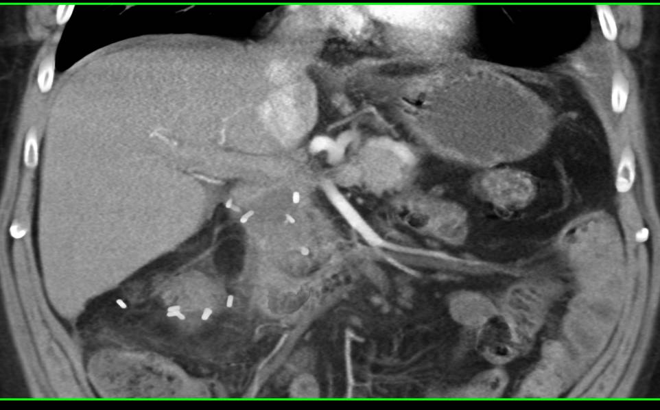 Recurrent Renal Cell Carcinoma with Liver Recurrence - CTisus CT Scan