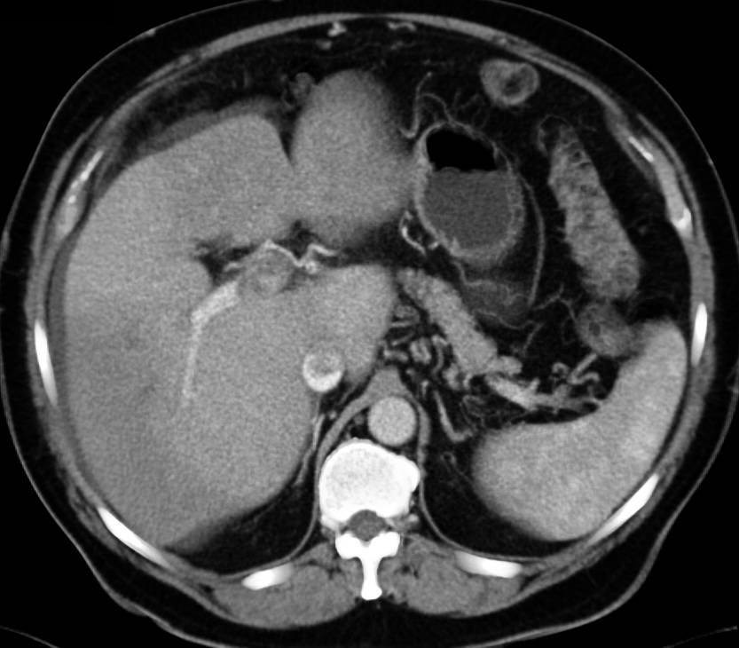 Hepatocellular Carcinoma (Hepatoma) Invades the Inferior Vena Cava (IVC) and Hepatic Veins - CTisus CT Scan