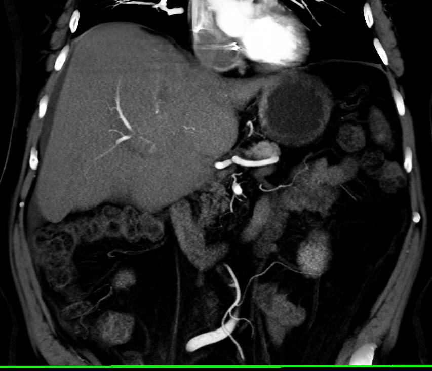 Hepatocellular Carcinoma (Hepatoma) with Neovascularity - CTisus CT Scan