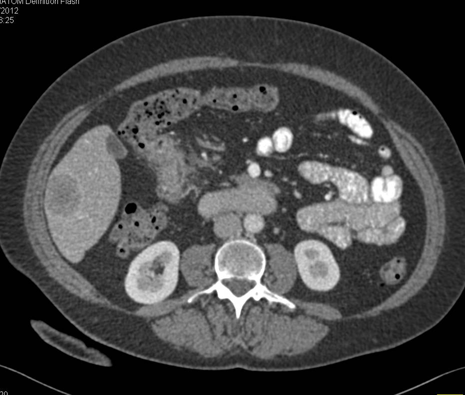 Duodenal Cancer with Liver Metastases - CTisus CT Scan