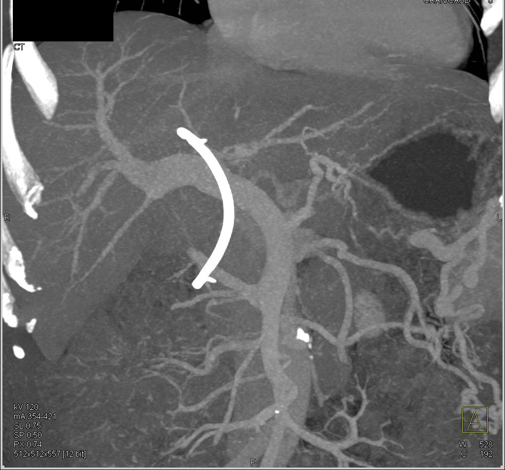 Dilated Common Duct with Stent in Distal CBD - CTisus CT Scan