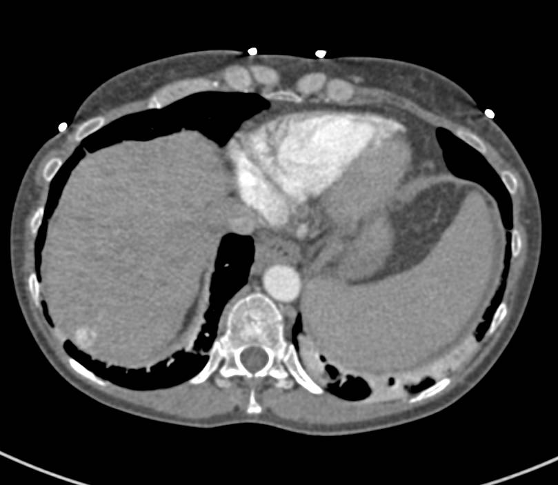 1 cm Hepatocellular Carcinoma (Hepatoma) in a Cirrhotic Liver - CTisus CT Scan