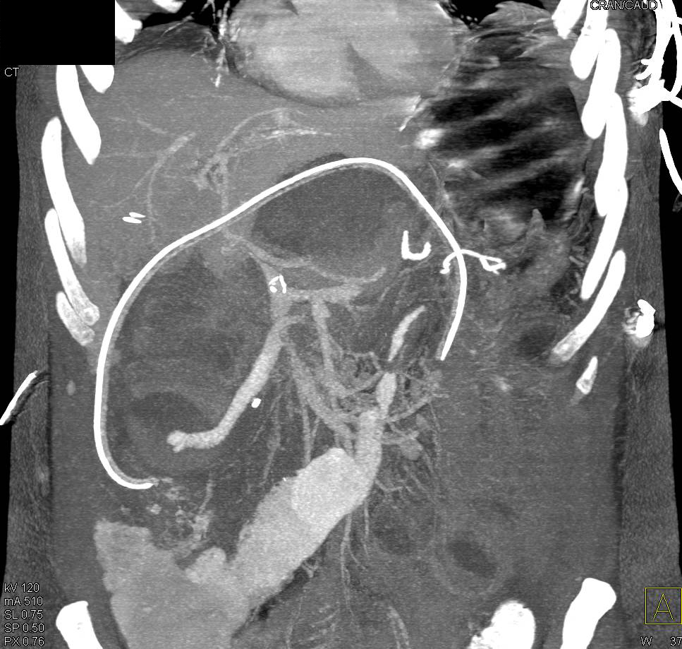 Perihepatic Bleed with Ascites - CTisus CT Scan