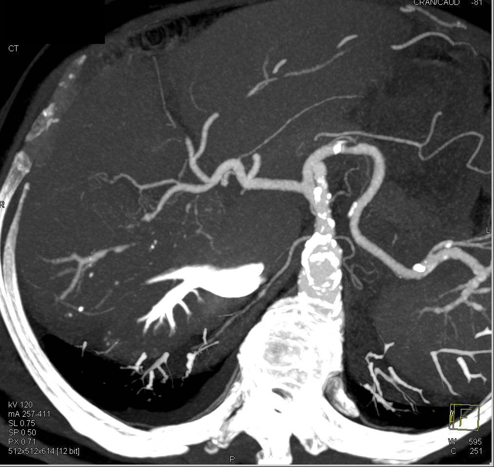 Hepatocellular Carcinoma (Hepatoma) Invades the Portal Vein - CTisus CT Scan