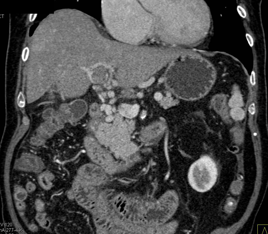 Cholangiocarcinoma with Extension into the Portal Vein - CTisus CT Scan