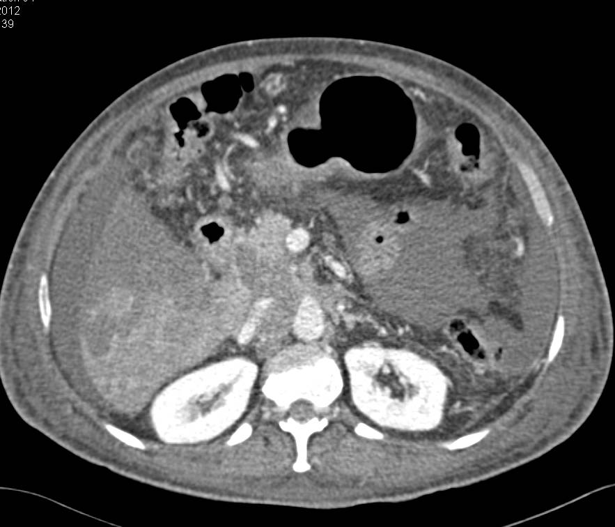 Hepatic Cholangiocarcinoma - CTisus CT Scan