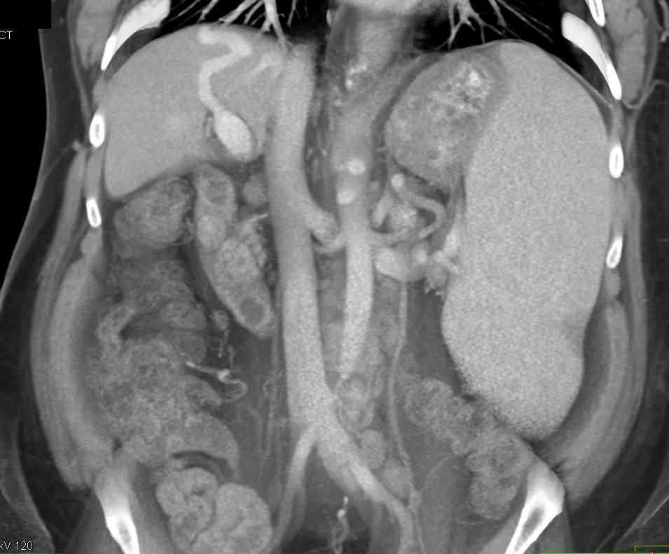 Cirrhosis with Arteriovenous (AV) Shunting and Portal Hypertension - CTisus CT Scan