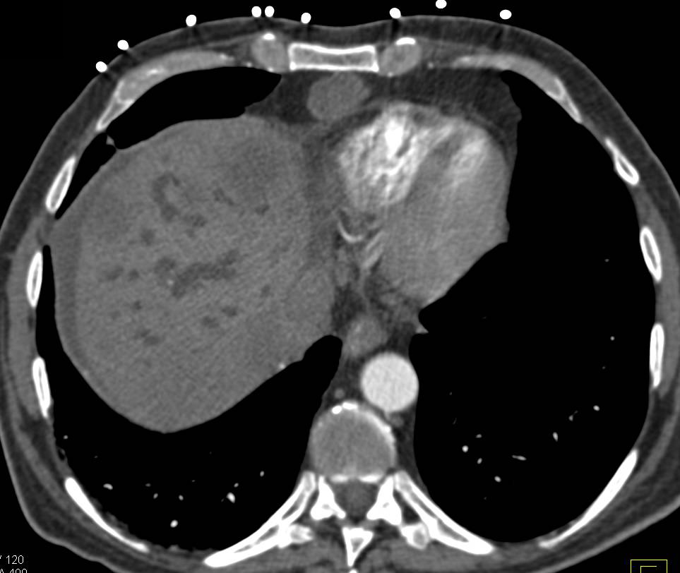 Hilar Cholangiocarcinoma - CTisus CT Scan