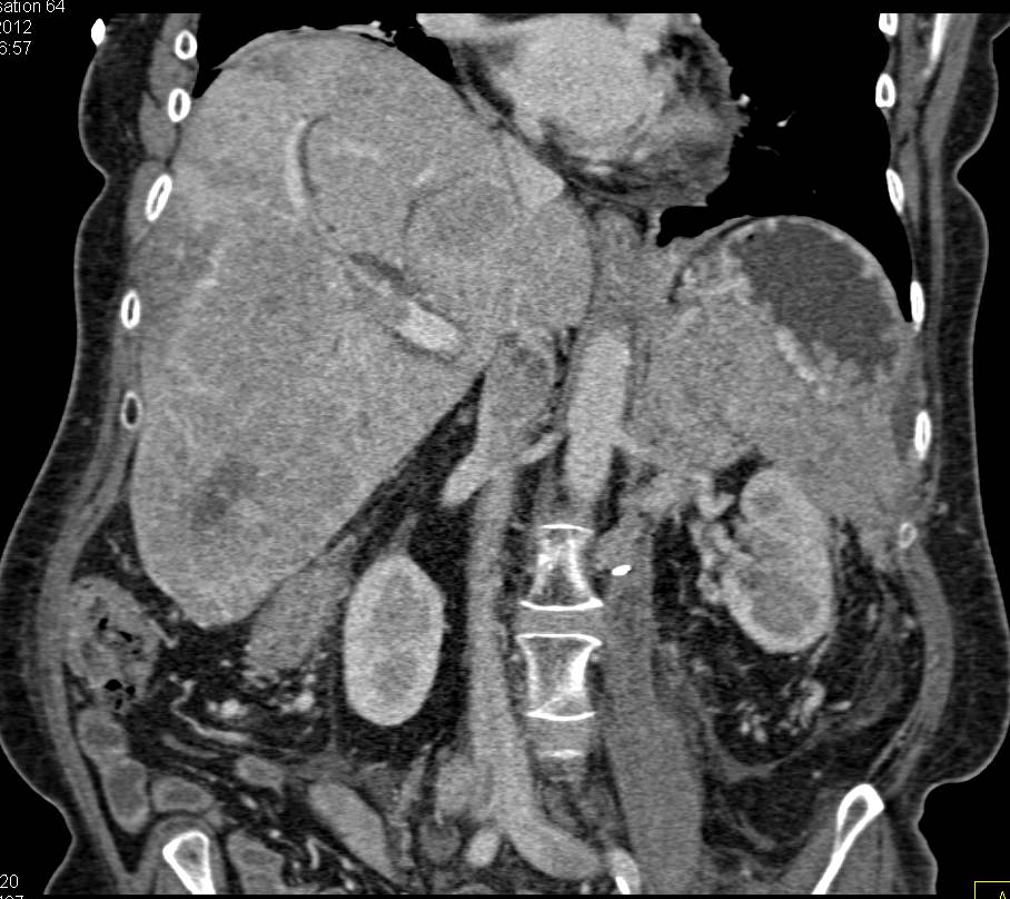 Liver Metastases Involve the Portal Vein - CTisus CT Scan