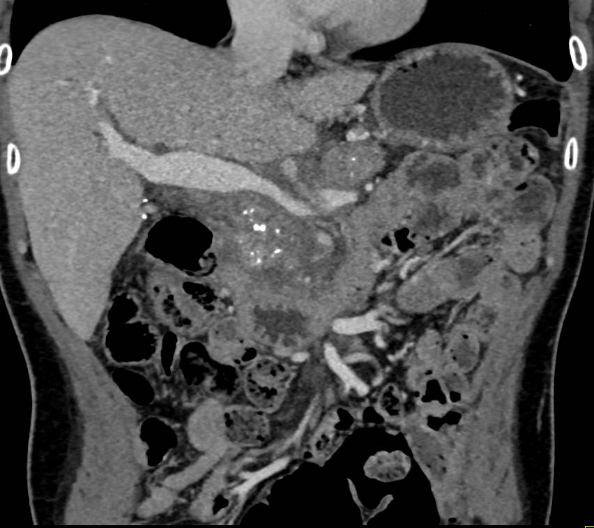 Chronic Pancreatitis with Narrowed Portal Vein - CTisus CT Scan