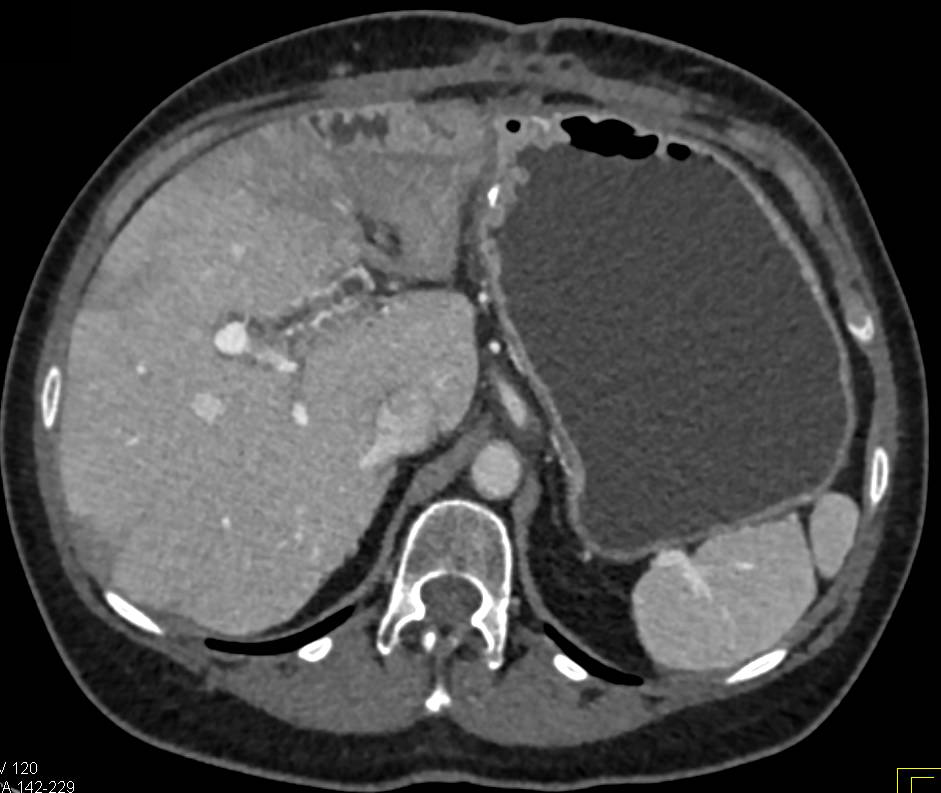 Hepatic Infarcts and Portal Vein Thrombosis (PVT) - CTisus CT Scan