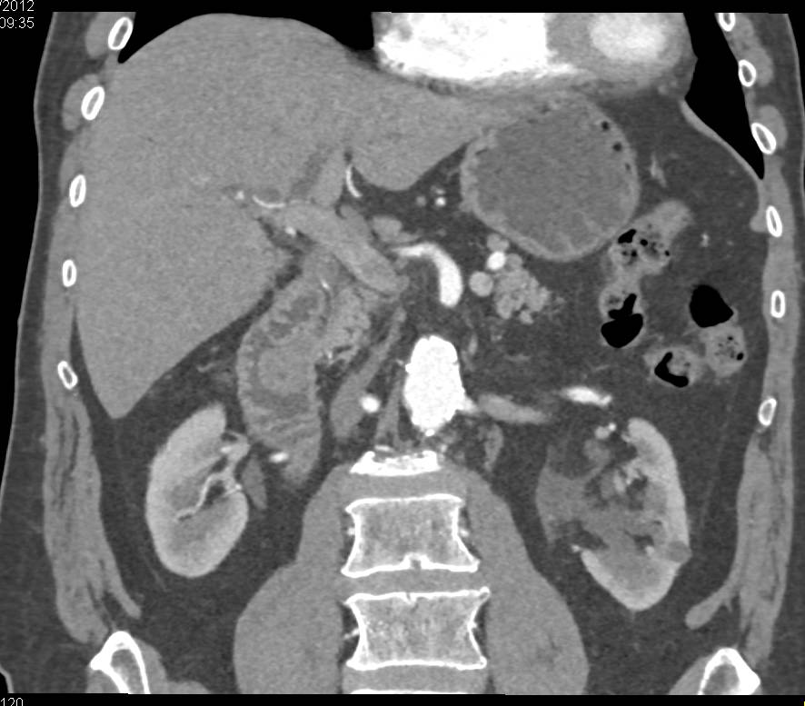 Common Bile Duct (CBD) Obstructed by Ampullary Carcinoma - CTisus CT Scan