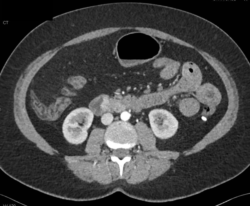 Carcinoid Tumor at Ampulla with Enhancement and Dilated Common Bile Duct (CBD) - CTisus CT Scan