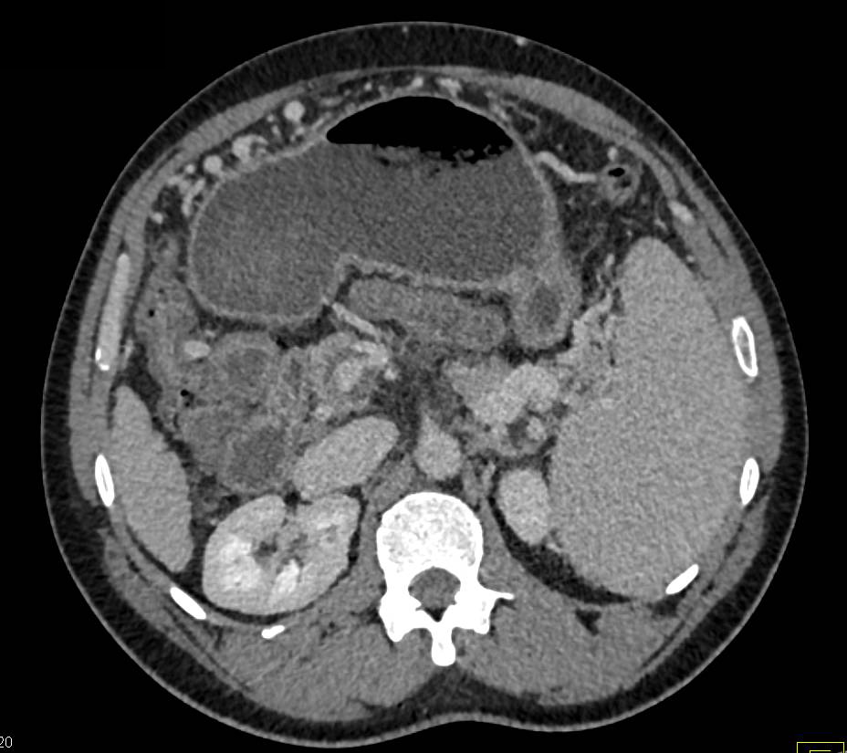 Cirrhosis with Portal Vein Thrombosis (PVT) and Collaterals - CTisus CT Scan