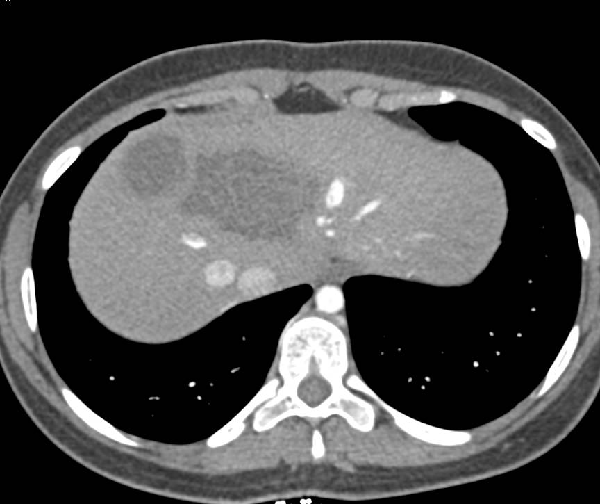 Unusual Example of Hydatid Liver Disease - CTisus CT Scan