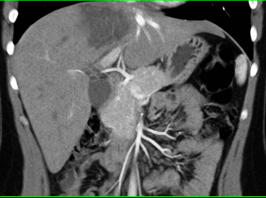 Unusual Example of Hydatid Liver Disease - CTisus CT Scan