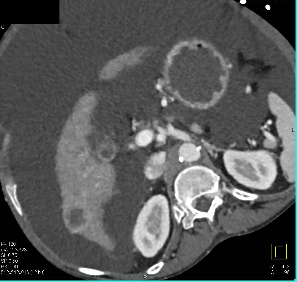 2 cm Hepatocellular Carcinoma (Hepatoma) in a Cirrhotic Liver - CTisus CT Scan