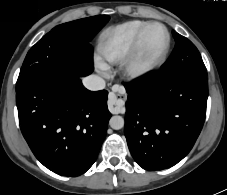 Cirrhosis with Recanalized Umbilical Vein - CTisus CT Scan