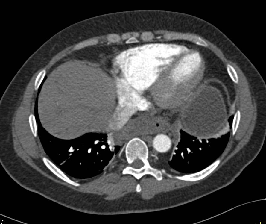 Cirrhosis with Portal Hypertension and a Pelvic Kidney - CTisus CT Scan