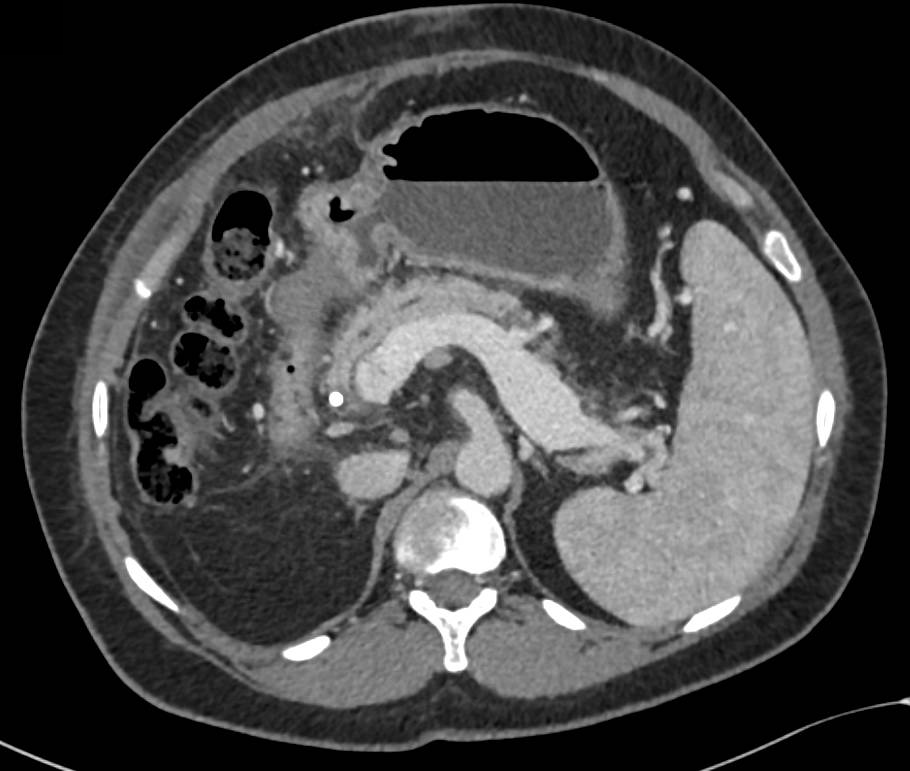 Cirrhosis with Portal Hypertension - CTisus CT Scan