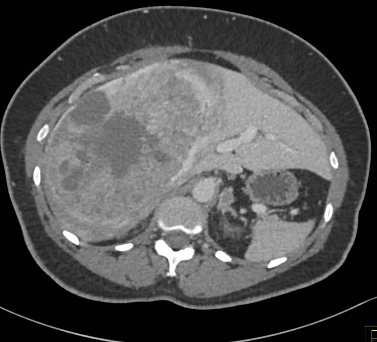 Hepatocellular Carcinoma (Hepatoma) with Neovascularity and Pseudocapsule - CTisus CT Scan