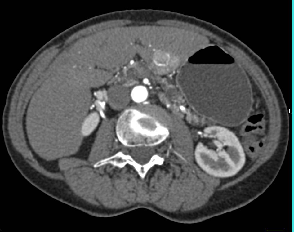 Focal Nodular Hyperplasia (FNH) in Left Lobe of the Liver - CTisus CT Scan