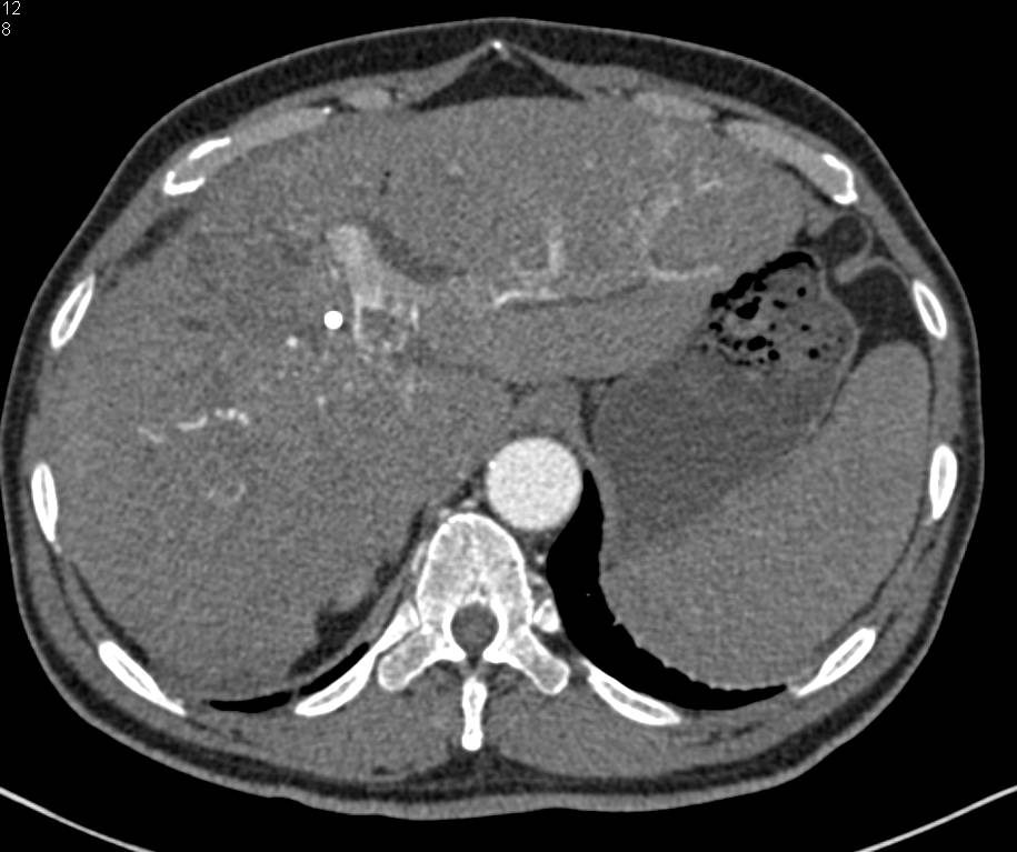 CTA Hepatocellular Carcinoma (Hepatoma) with Portal Vein Invasion and Collaterals - CTisus CT Scan