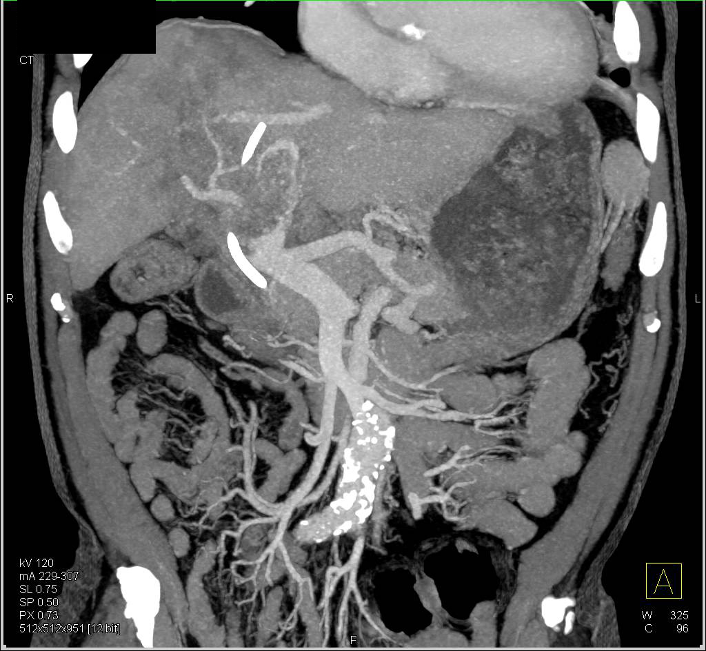 CTA Hepatocellular Carcinoma (Hepatoma) with Portal Vein Invasion and Collaterals (Additional Phases) - CTisus CT Scan