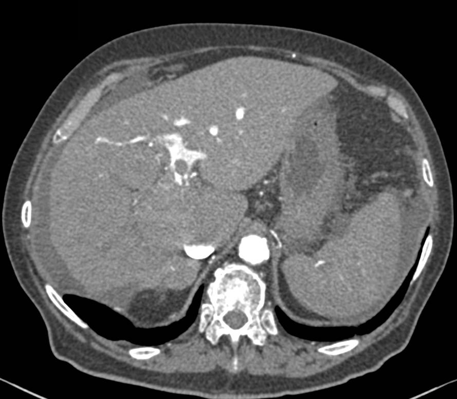 Hepatocellular Carcinoma (Hepatoma) with Neovascularity and Portal Vein Invasion - CTisus CT Scan