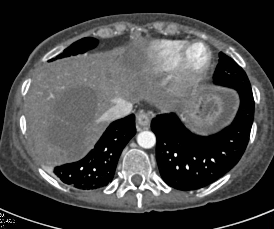 Liver Abscess - CTisus CT Scan