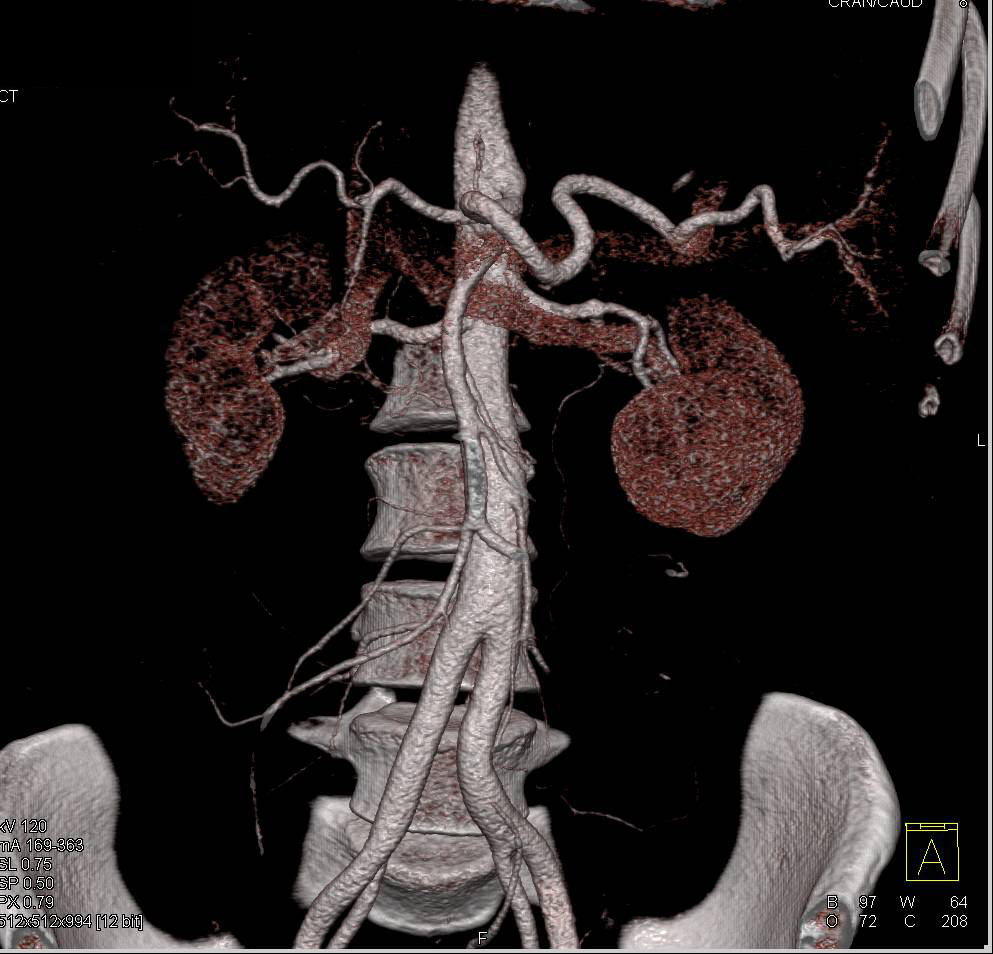 Metastatic Renal Cell Carcinoma to the Liver - CTisus CT Scan