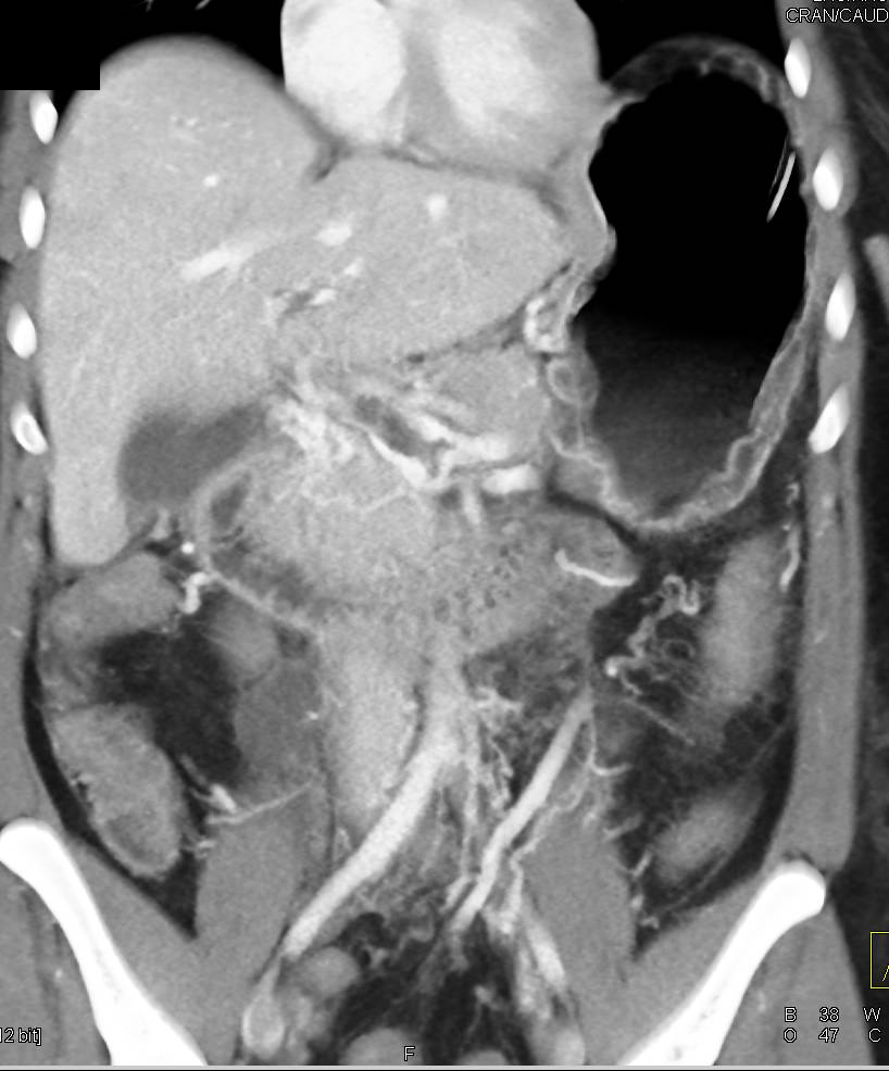 Non occlusive Portal Vein Thrombosis Liver Case Studies CTisus CT 