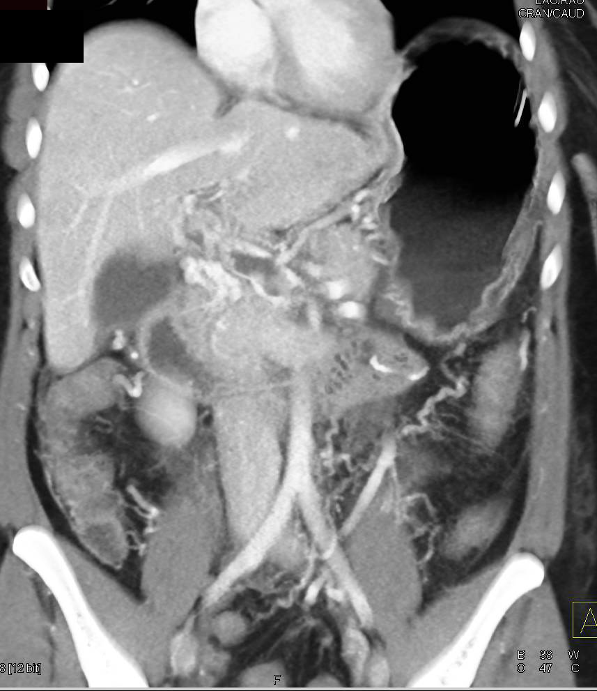 Non-occlusive Portal Vein Thrombosis - CTisus CT Scan