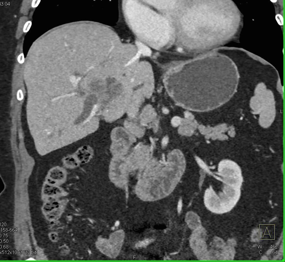 Incidental Pulmonary Embolism (PE) in a Patient with a Central Cholangiocarcinoma - CTisus CT Scan