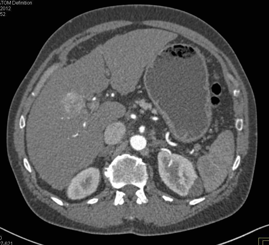 Hepatocellular Carcinoma (Hepatoma) in a Cirrhotic Liver - CTisus CT Scan