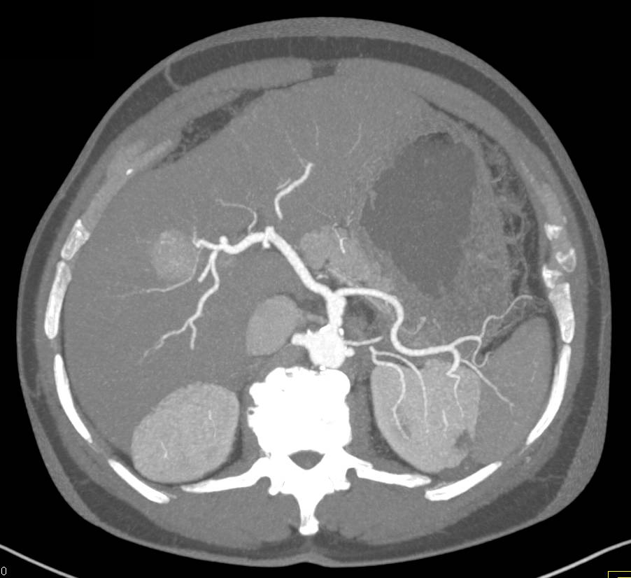 Hepatocellular Carcinoma (Hepatoma) with 3D CTA and Neovascularity - CTisus CT Scan