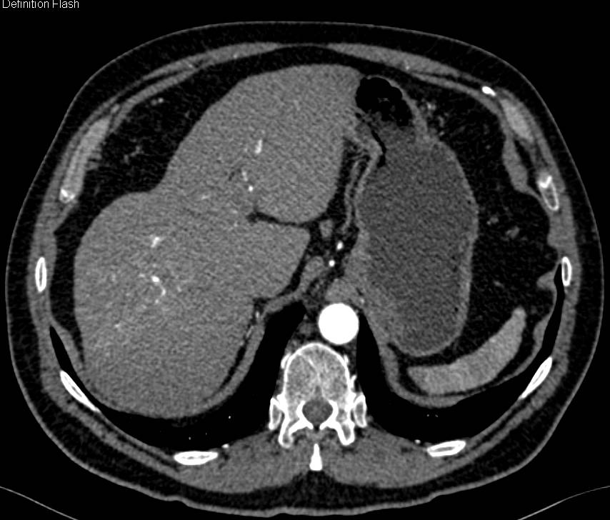 Subtle Hepatocellular Carcinoma (Hepatoma) in Right Lobe of the Liver with Neovascularity - CTisus CT Scan