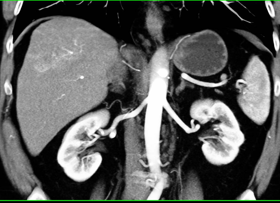 Subtle Hepatocellular Carcinoma (Hepatoma) in Right Lobe of the Liver with Neovascularity - CTisus CT Scan