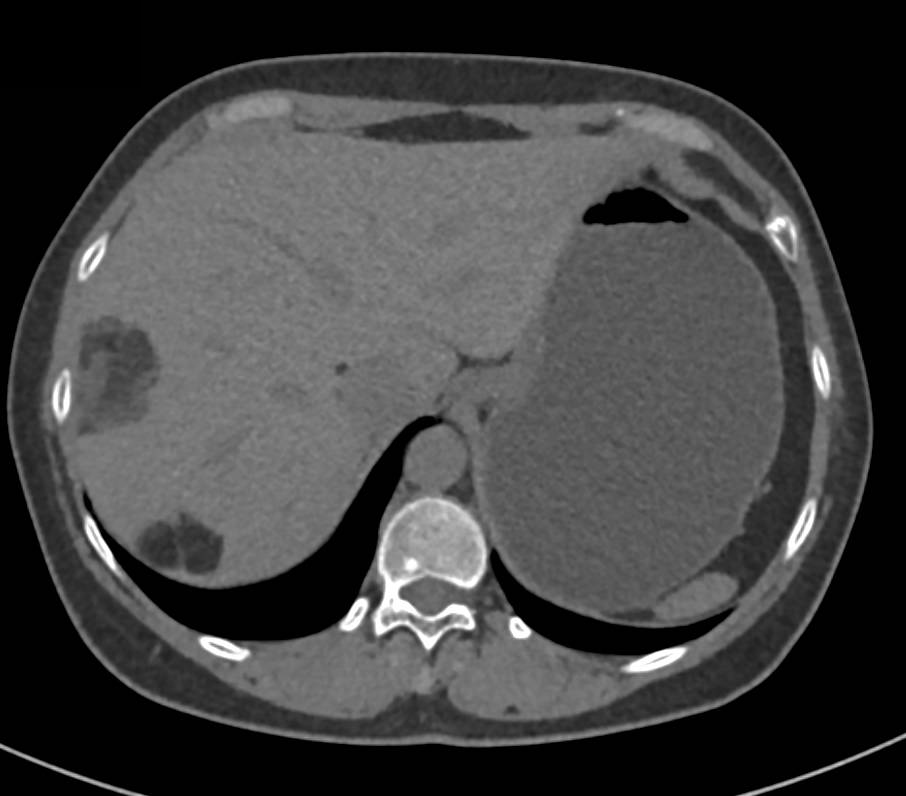 Incredible Case of Hepatic and Renal Angiomyolipomas - CTisus CT Scan