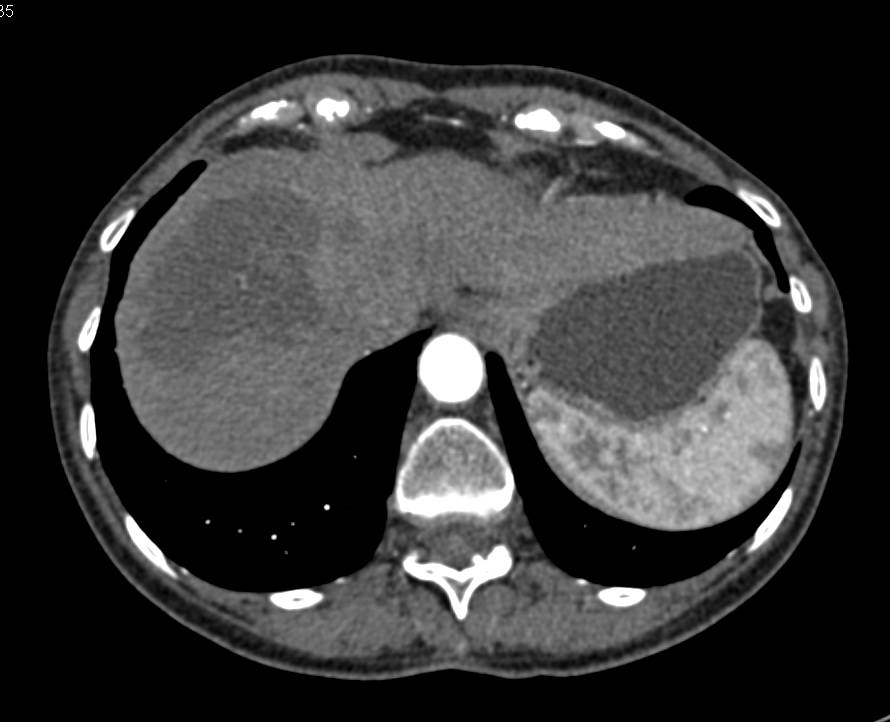 Necrotic Liver Metastases - CTisus CT Scan