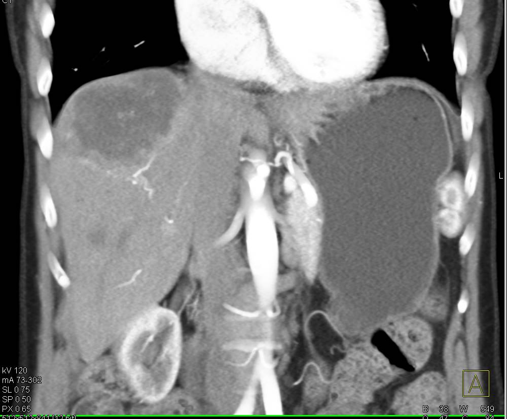 Necrotic Liver Metastases due to Metastatic GIST Tumor - CTisus CT Scan