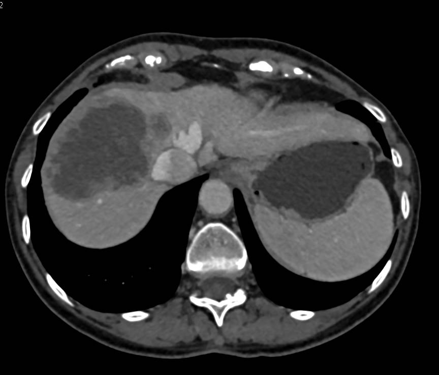Necrotic Liver Metastases due to Metastatic GIST Tumor - Liver Case