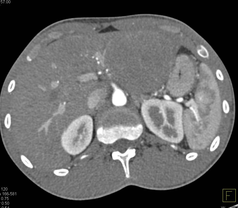 Metastatic GIST Tumor to the Liver Best Seen on Venous Phase Images - CTisus CT Scan