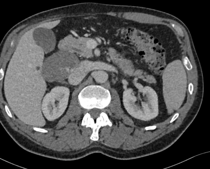 Hepatic Hemangioma Simulates a Peripancreatic Mass - CTisus CT Scan