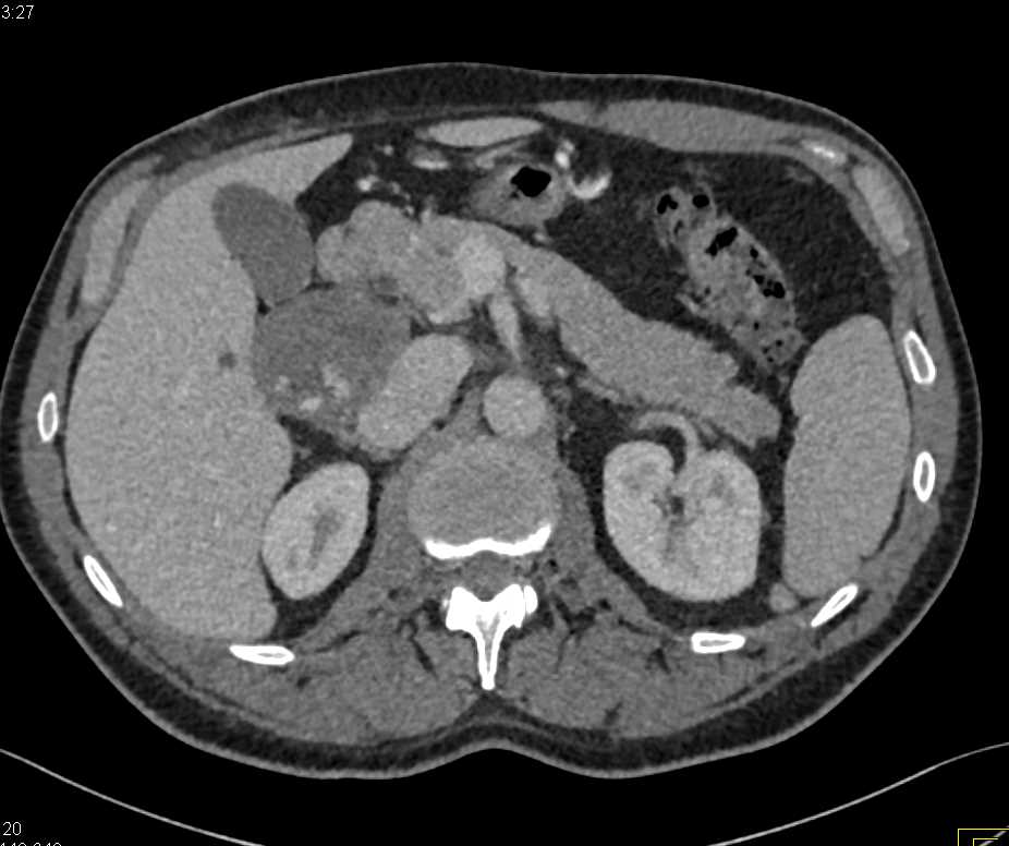 Hemangioma Medially in Liver Simulated a Peripancreatic Tumor - CTisus CT Scan