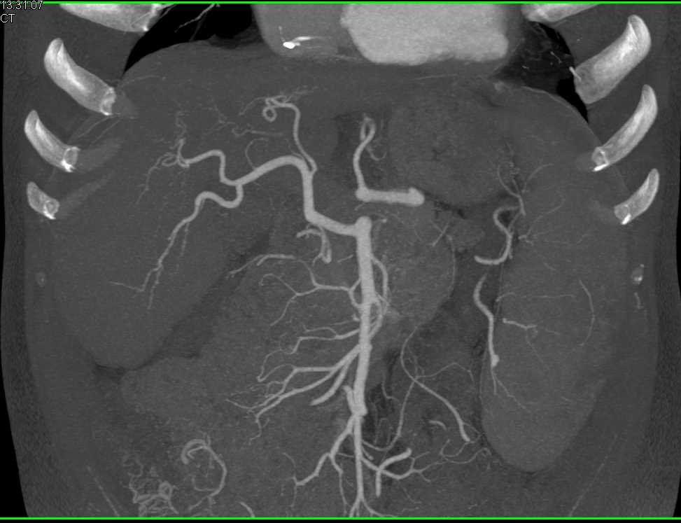 Hepatic Artery Arises off the SMA - CTisus CT Scan