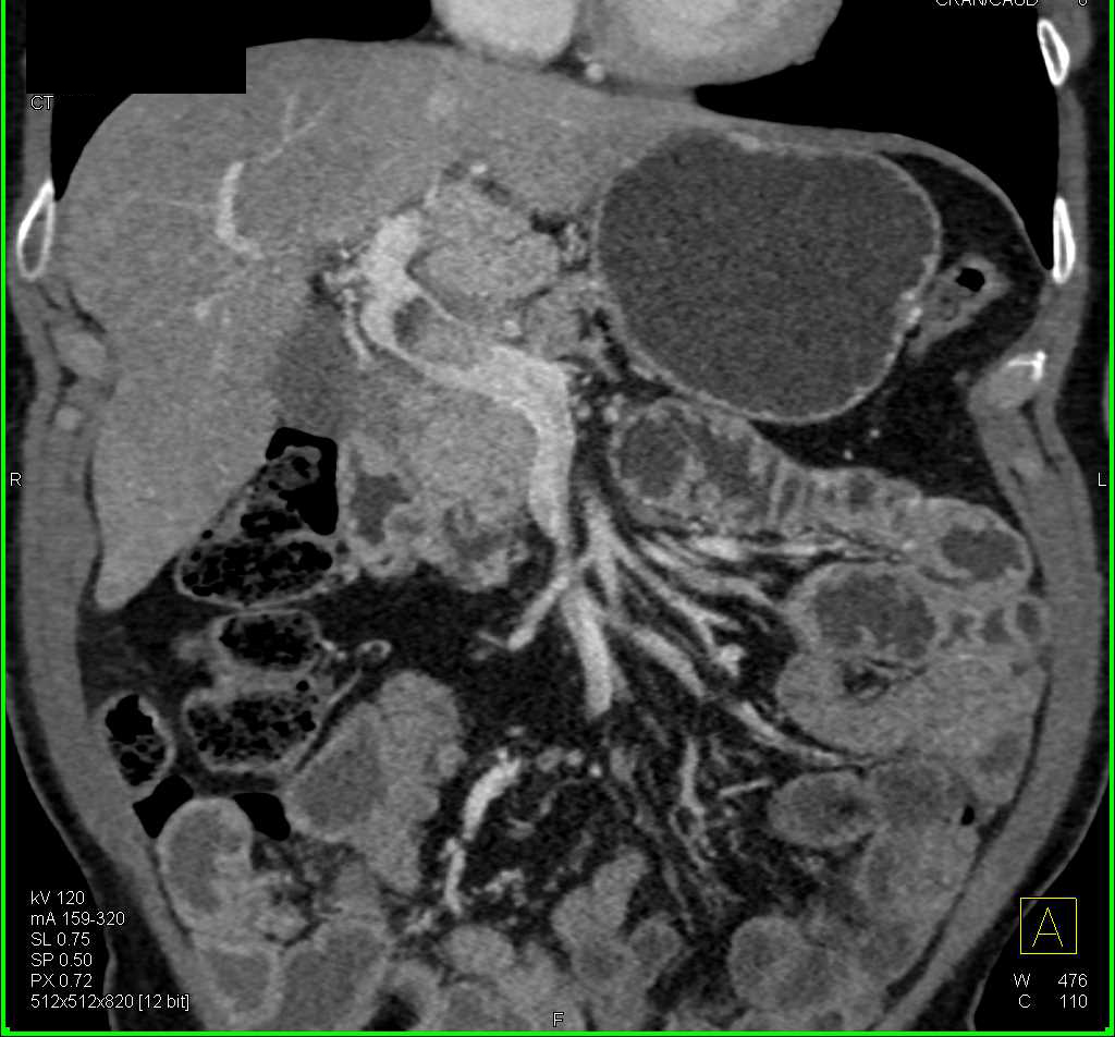 Cholangiocarcinoma with Port0caval Adenopathy and Portal Vein Thrombosis - CTisus CT Scan